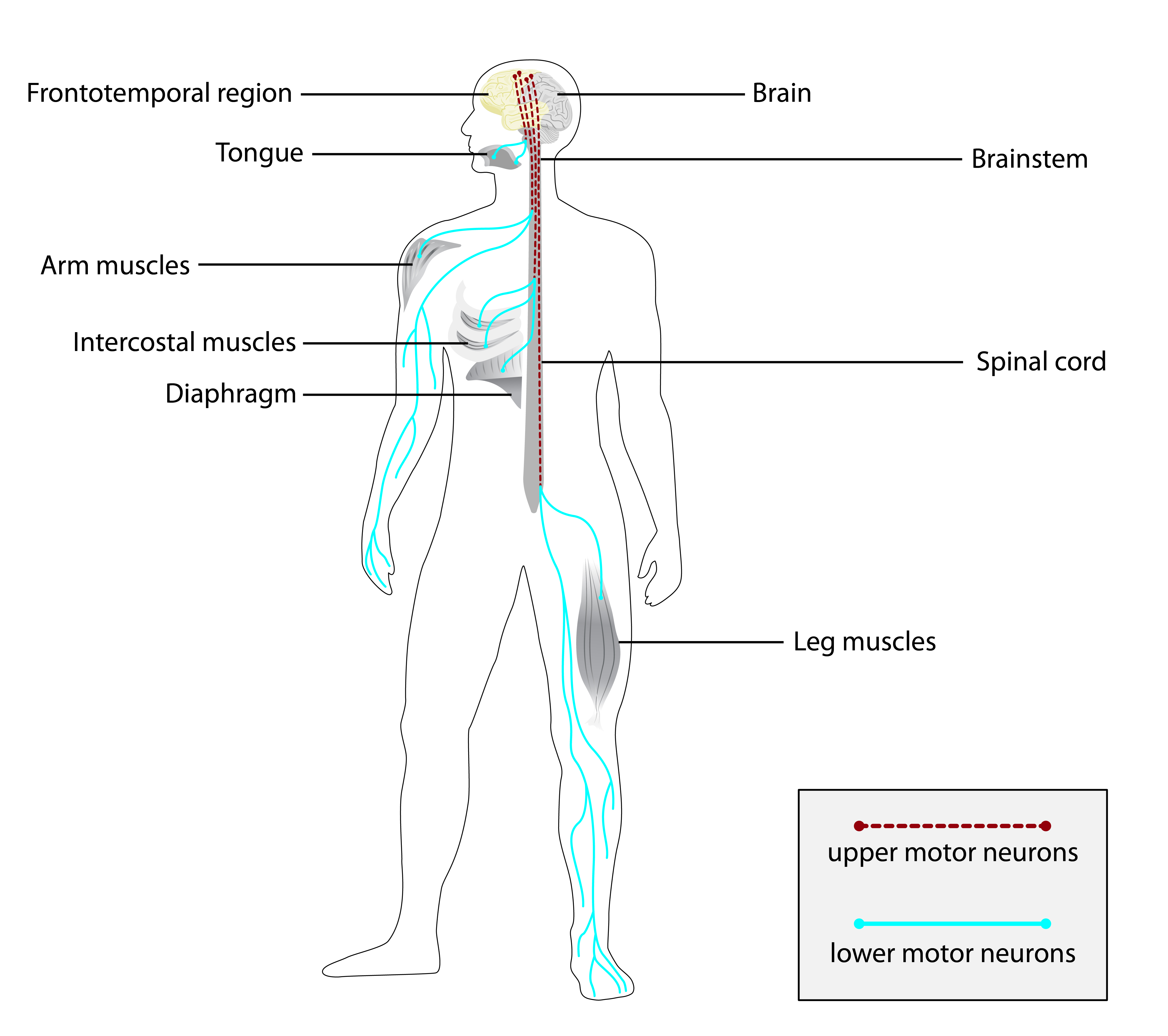 Các nhà nghiên cứu xác định các biến thể di truyền quan trọng liên quan đến sự phục hồi của bệnh ALS